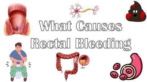 blood in stool after anal sex|Patient education: Blood in the stool (rectal bleeding) in adults .